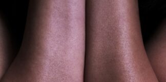 a close up of a person's legs with white spots on them